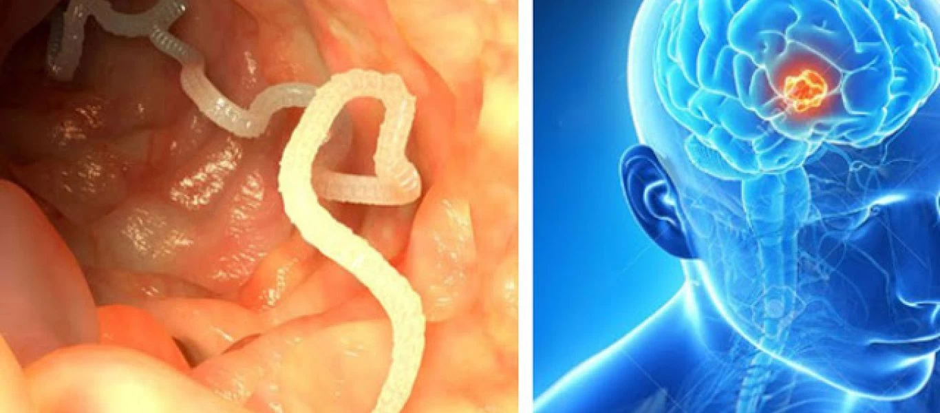 Άνδρας έφαγε χοιρινό που δεν είχε μαγειρευτεί καλά και ο εγκέφαλός του γέμισε... σκουλήκια (φωτο)